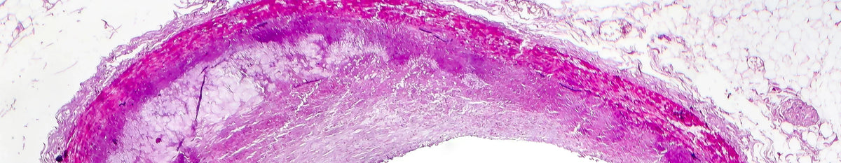 Effect of gut health on heart, how gut dysbiosis can increase your risk of atherosclerosis